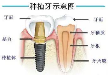 人工植牙价格的时代变迁与口腔健康投资的重要性